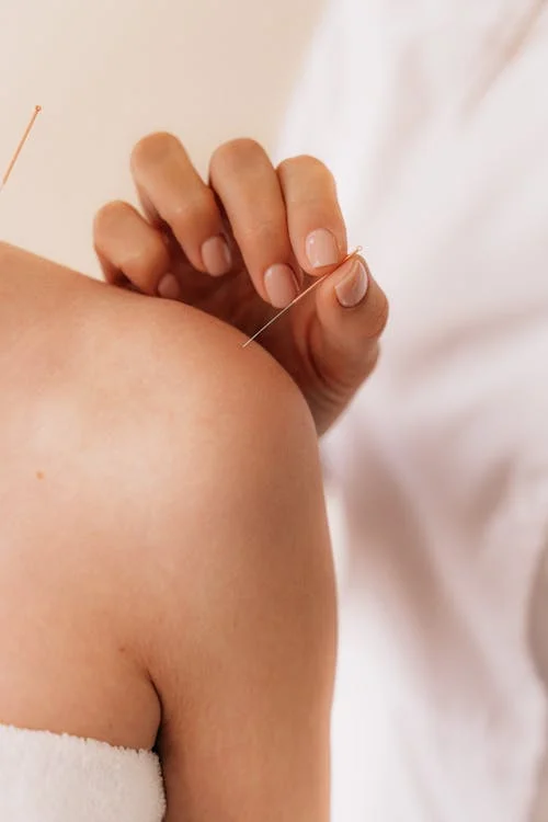 Acupuncture treatment & ACC treatment at Takapuna Massage